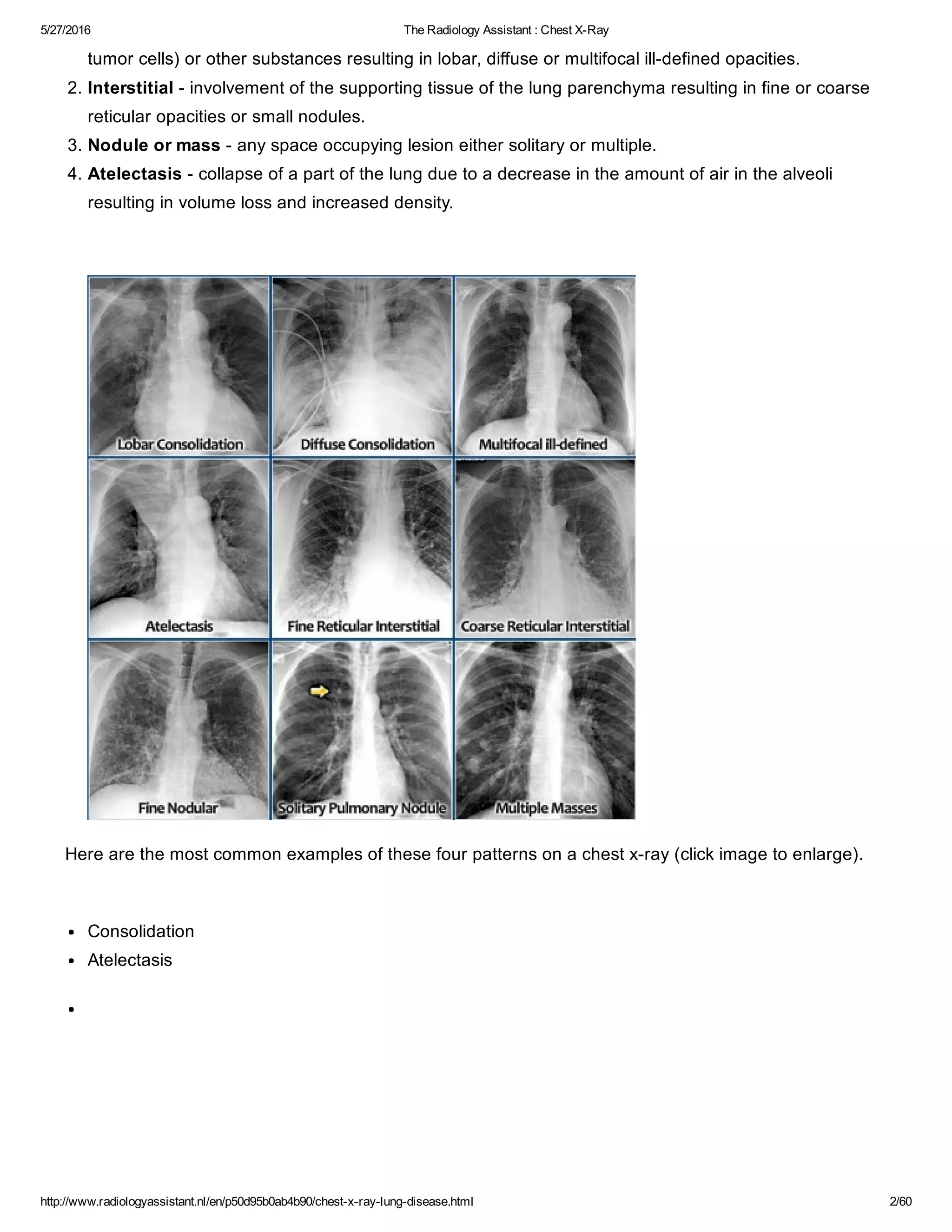 The Radiology Assistant Chest X Ray Lung Disease