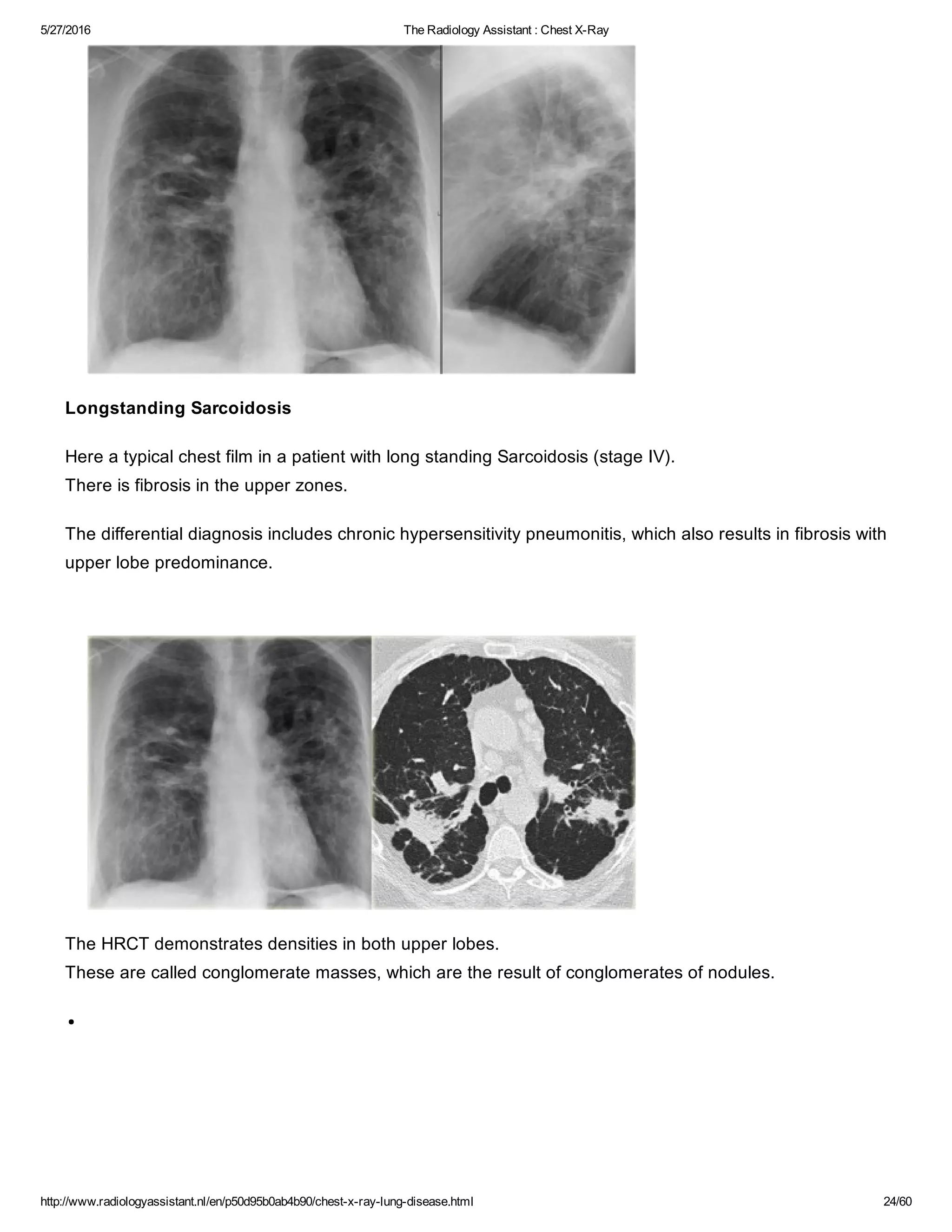 The radiology assistant chest x ray - lung disease | PDF
