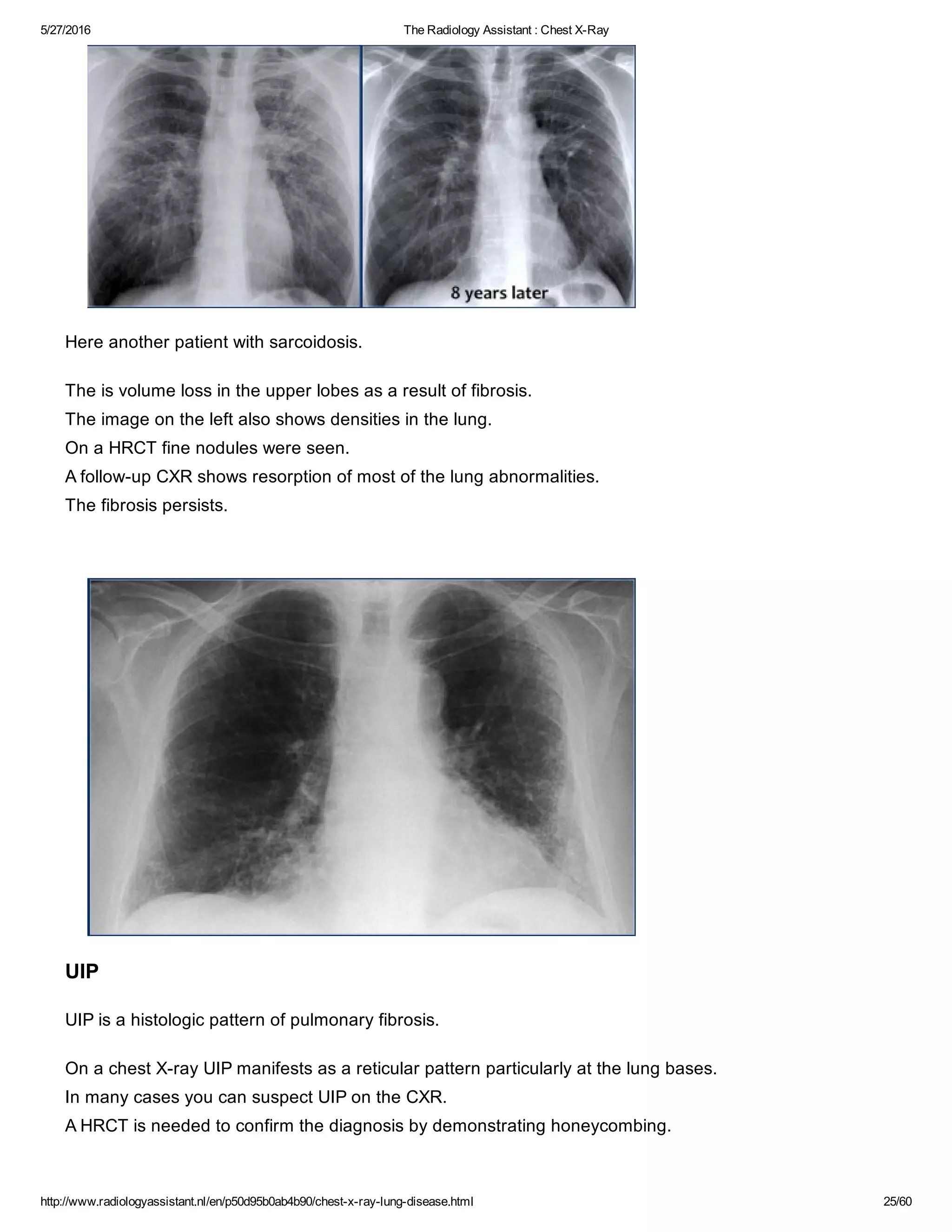 The radiology assistant chest x ray - lung disease | PDF