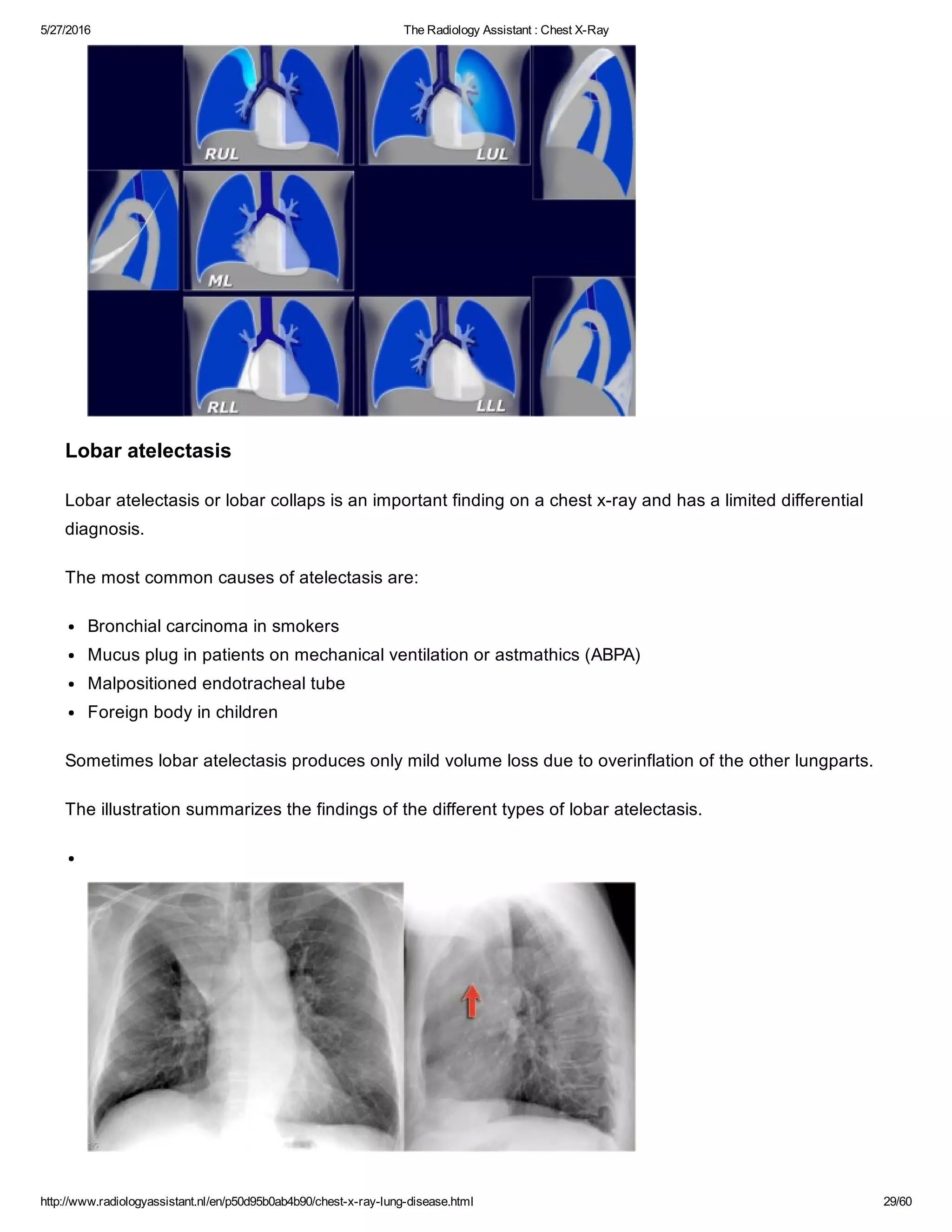 The radiology assistant chest x ray - lung disease | PDF