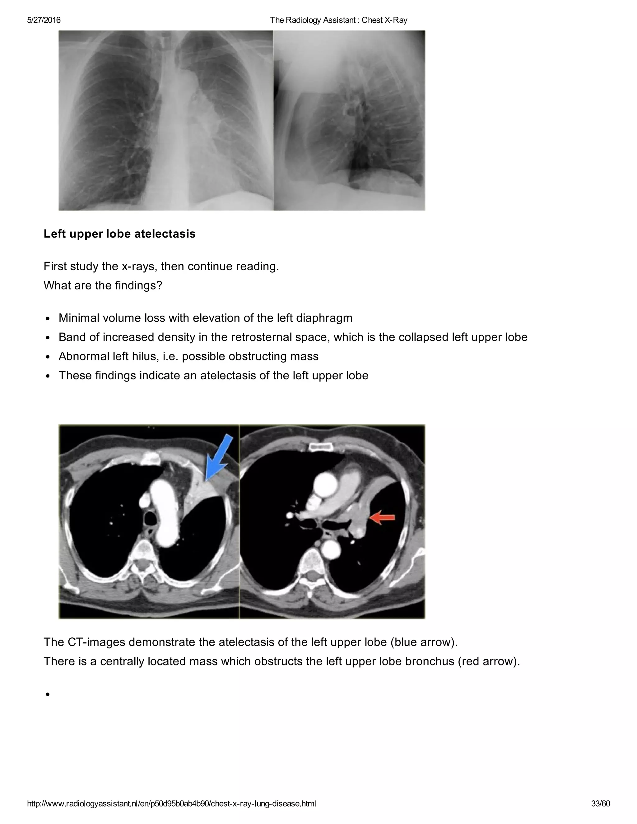 The radiology assistant chest x ray - lung disease | PDF