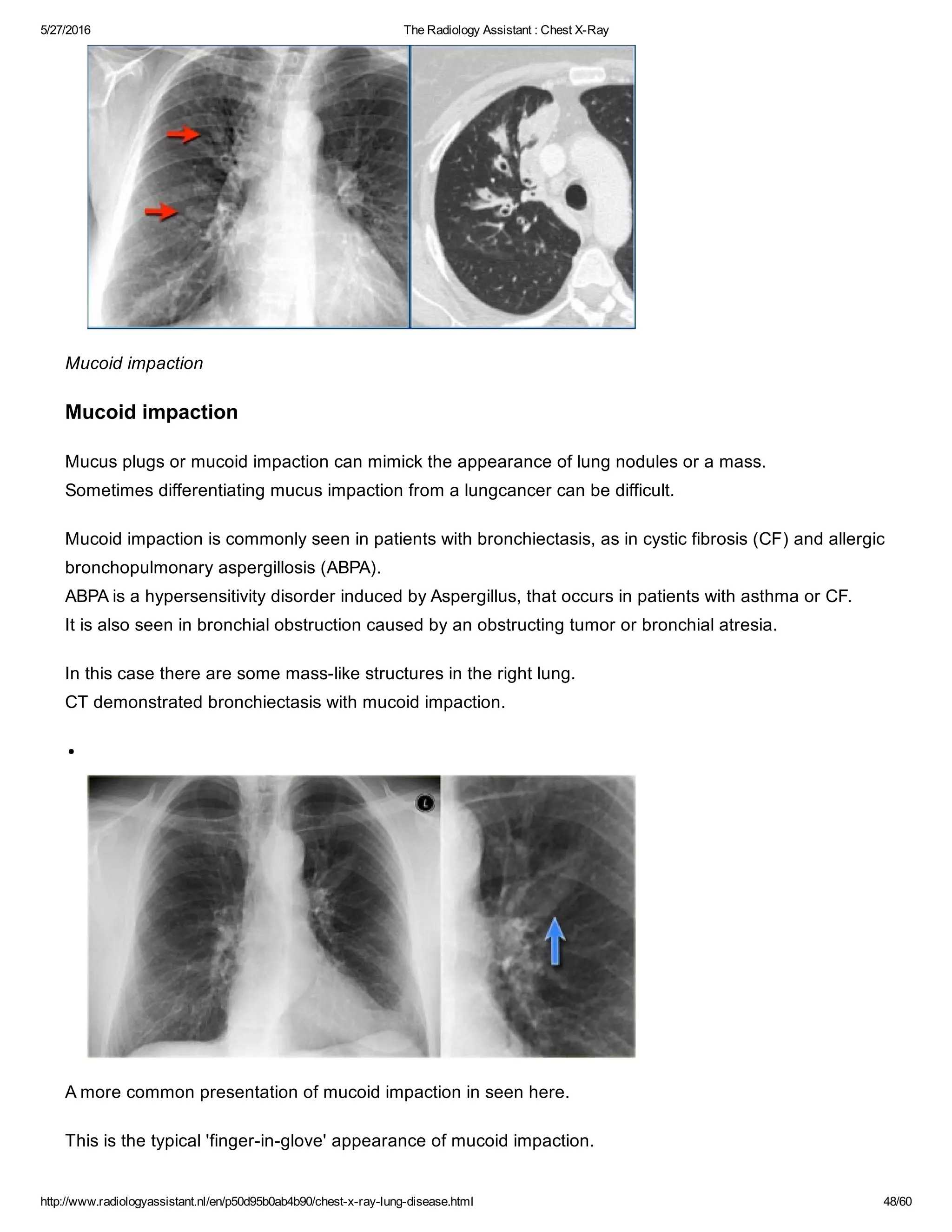 Mucoid Plug The radiology assistant chest x ray - lung disease | PDF