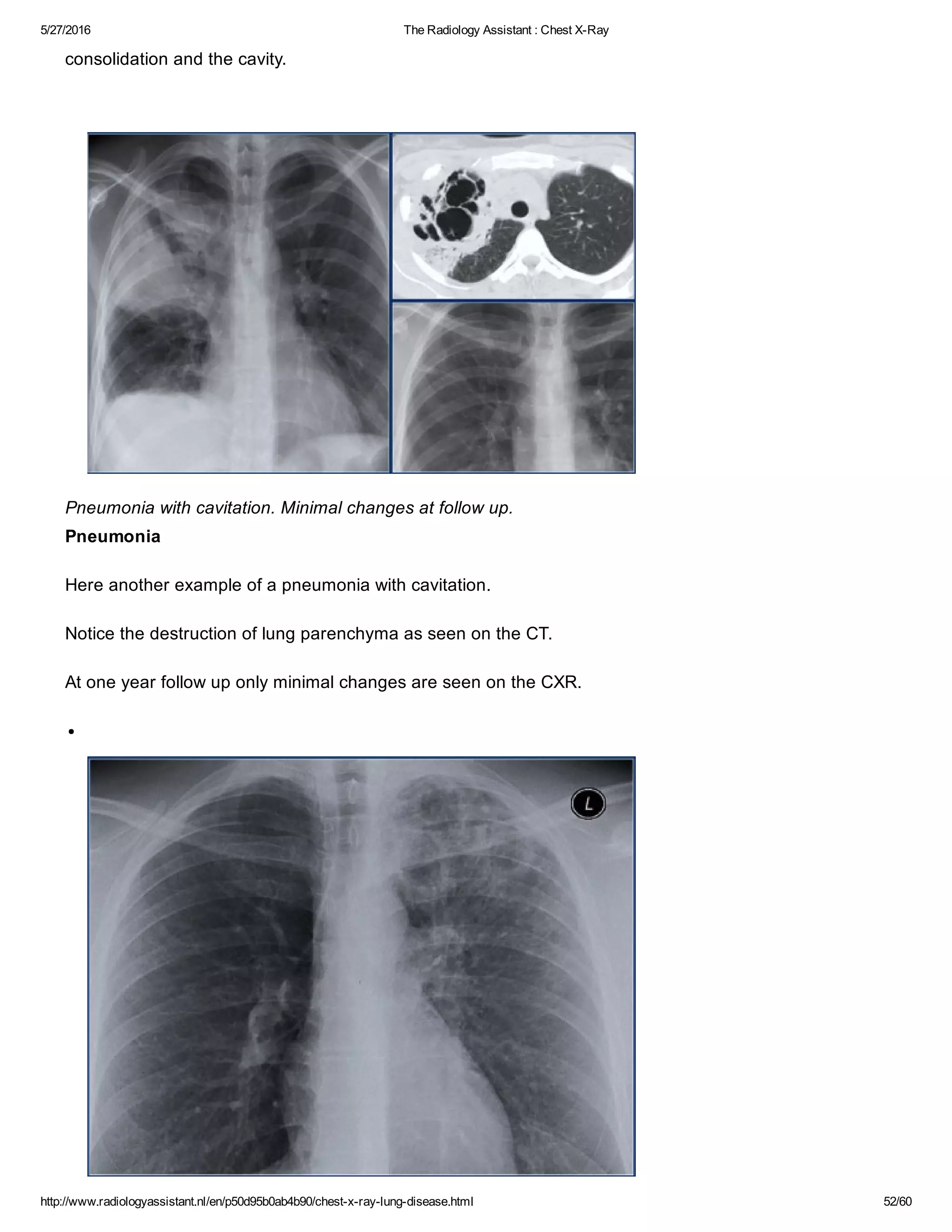 The radiology assistant chest x ray - lung disease | PDF