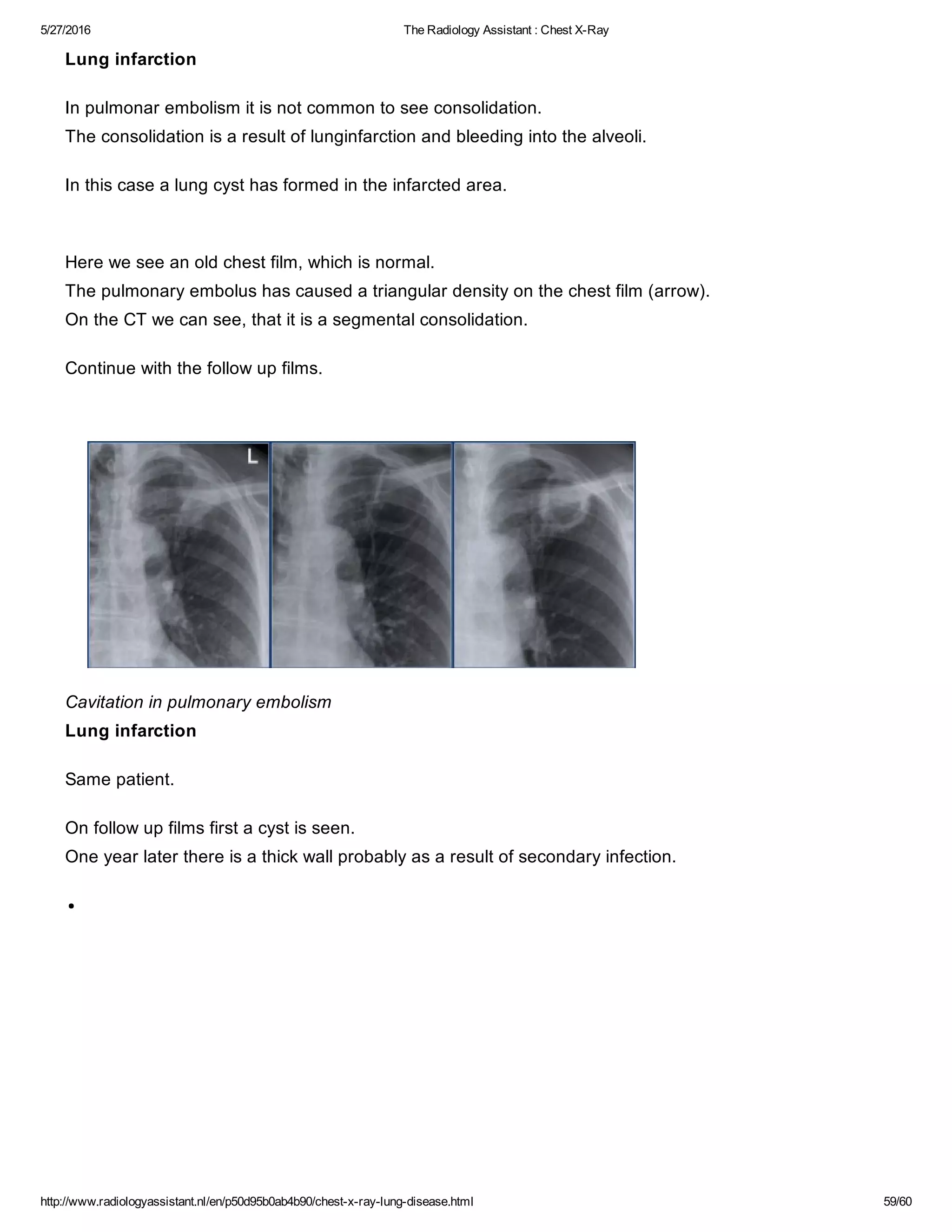 The radiology assistant chest x ray - lung disease | PDF