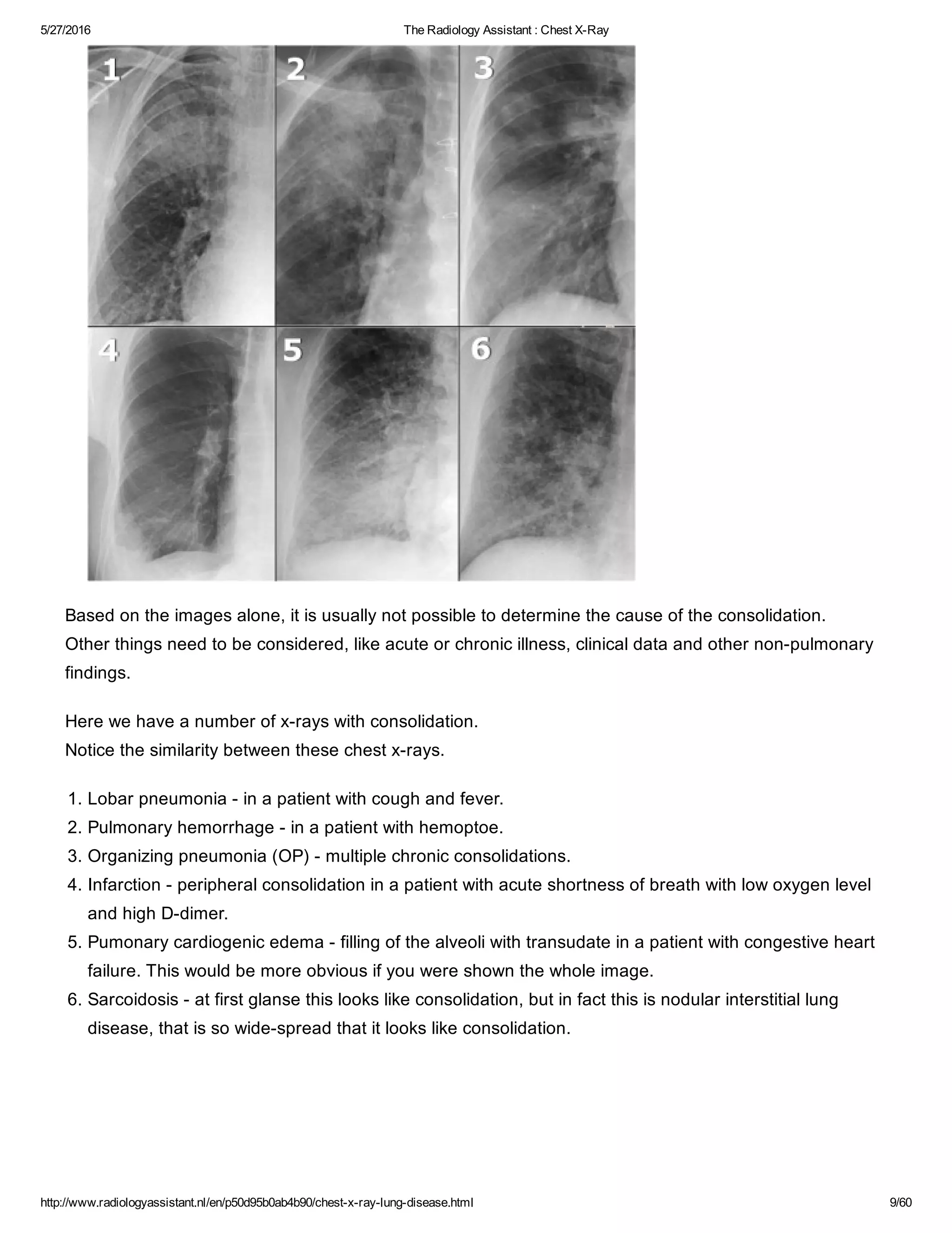 The radiology assistant chest x ray - lung disease | PDF