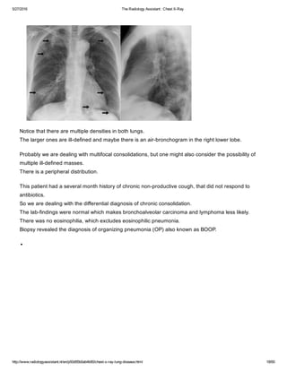 The radiology assistant chest x ray - lung disease | PDF