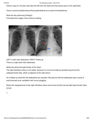 The radiology assistant chest x ray - lung disease | PDF