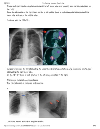 The radiology assistant chest x ray - lung disease | PDF