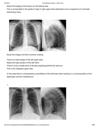 The Radiology Assistant Chest X Ray Lung Disease