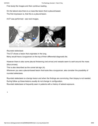 The radiology assistant chest x ray - lung disease | PDF