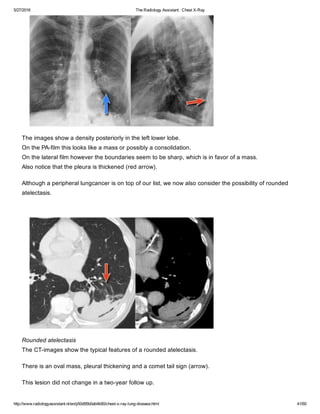 The radiology assistant chest x ray - lung disease | PDF