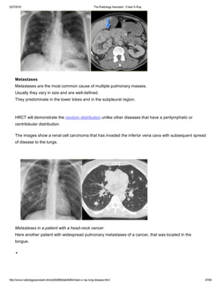 The radiology assistant chest x ray - lung disease | PDF