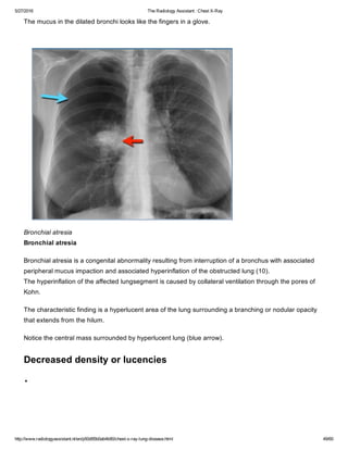 The Radiology Assistant Chest X Ray Lung Disease