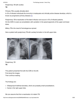 The radiology assistant chest x ray - lung disease | PDF