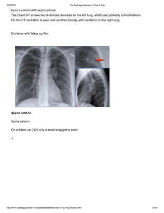 The radiology assistant chest x ray - lung disease | PDF