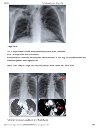 The radiology assistant chest x ray - lung disease | PDF