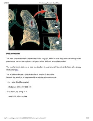 The Radiology Assistant Chest X Ray Lung Disease