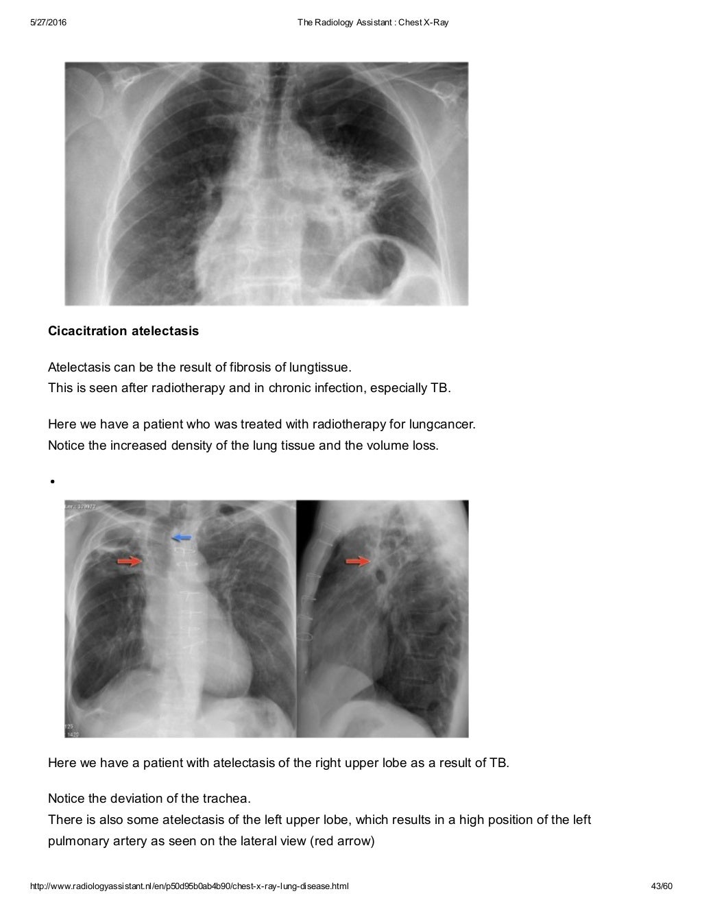 The radiology assistant chest x ray lung disease