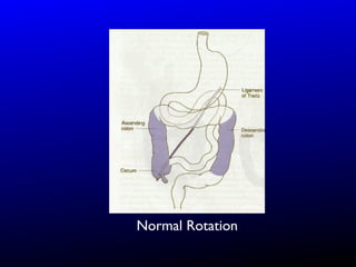 Clockwise Mesenter Rotation Normal The Radiology of Malrotation | PPT