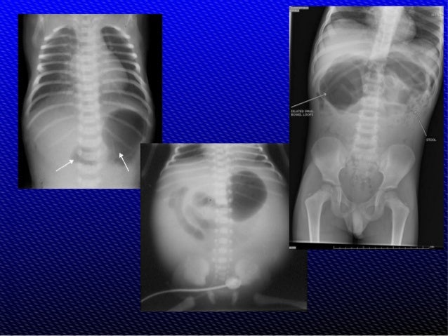 The Radiology of Malrotation