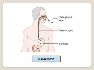 Nasogastric
 