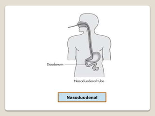 Nasoduodenal
 