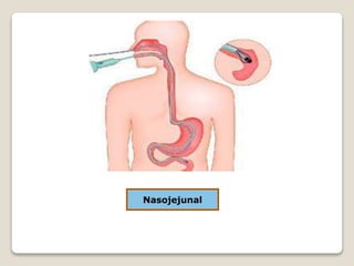 Nasojejunal
 