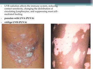 • UVB radiation affects the immune system, reducing
contact sensitivity, changing the distribution of
circulating lymphocytes, and suppressing mast cell–
mediated healing
• psoralen with UVA (PUVA)
• vitiligo UVB (PUVA)
 