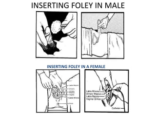 INSERTING FOLEY IN MALE
INSERTING FOLEY IN A FEMALE
 