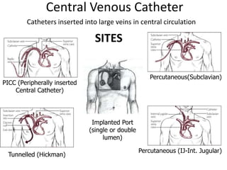 Central Venous Catheter
PICC (Peripherally inserted
Central Catheter)
Percutaneous(Subclavian)
Percutaneous (IJ-Int. Jugular)
Tunnelled (Hickman)
Implanted Port
(single or double
lumen)
Catheters inserted into large veins in central circulation
SITES
 