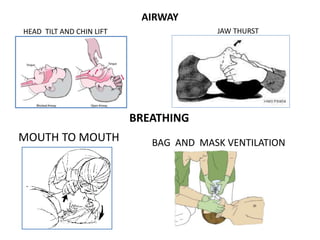 AIRWAY
HEAD TILT AND CHIN LIFT JAW THURST
BREATHING
BAG AND MASK VENTILATIONMOUTH TO MOUTH
 