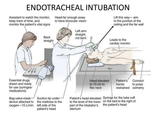 ENDOTRACHEAL INTUBATION
 
