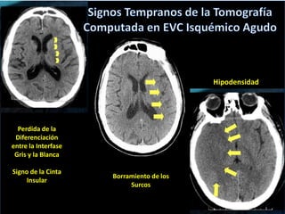 Hipodensidad




  Perdida de la
 Diferenciación
entre la Interfase
 Gris y la Blanca

Signo de la Cinta
                     Borramiento de los
    Insular
                          Surcos
 