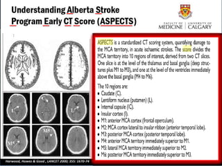 ASPECTS : Alberta Stroke Program Early CT score


   Escala en Score ASPECTS 10 Puntos




Harwood, Huwez & Good , LANCET 2000; 355: 1670-74
 