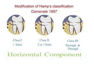 Hamp Classification PPT - TREATMENT IN FURCATION INVOLVEMENT.pptx