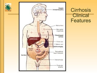Cirrhosis
Clinical
Features
 