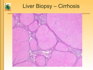 Liver Biopsy – Cirrhosis
 
