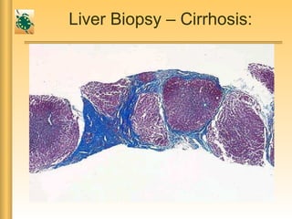 Liver Biopsy – Cirrhosis:
 