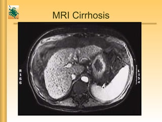 MRI Cirrhosis
 
