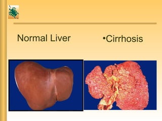 Normal Liver •Cirrhosis
 