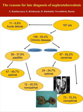 The reasons for late diagnosis of nephrotuberculosis
    E. Kulchavenya, E. Brizhatyuk, D. Kholtobin. Novosibirsk, Russia




   11 - 6,6%
  Acute debute                                          167 pts



                          156 - 93,4%
                         Chronic disease


                        4,8 months     27,3 months

     59 - 37,8%                                      97 - 62,2%
      papillitis                                      cavernas




  47 - 49,7%                         24 - 24,7%
   optimal                            optimal


                  12 - 20,3%
                  nonoptimal


                                                        73 - 75,3%
                                                        nonoptimal
 