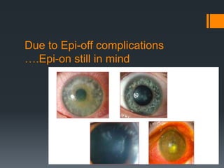 Due to Epi-off complications
….Epi-on still in mind
 
