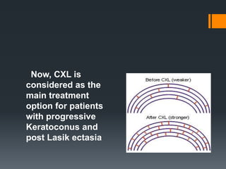 Now, CXL is
considered as the
main treatment
option for patients
with progressive
Keratoconus and
post Lasik ectasia
 