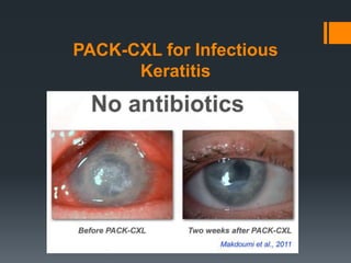PACK-CXL for Infectious
Keratitis
 