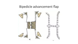 THE RECONSTRUCTIVE LADDER BY DR BINOD CHAUDHARY | PPTX