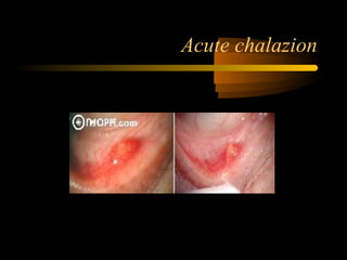 Acute chalazion
 