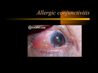 Allergic conjunctivitis
 