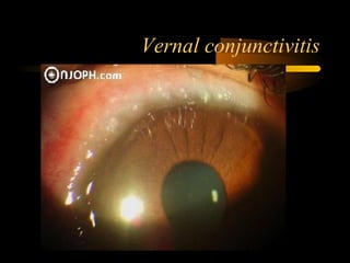 Vernal conjunctivitis
 