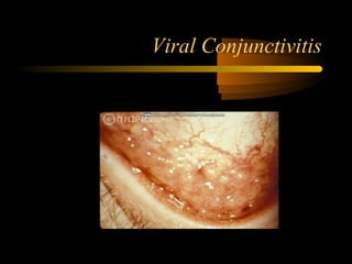 Viral Conjunctivitis
 