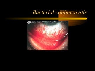 Bacterial conjunctivitis
 